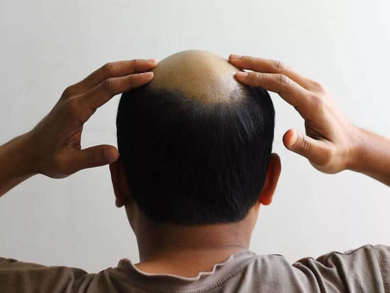 Przyczyny wypadania włosów u mężczyzn i jego leczenie